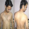 f636dee6_psoraisis2